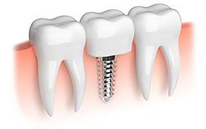 хирургическая-стоматология-имплантация